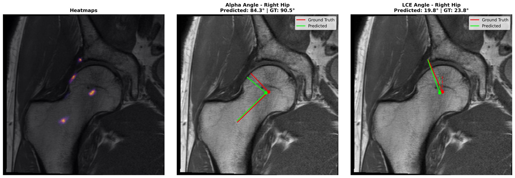 Automated landmark detection on a coronal T1-weighted hip MRI slice: predicted landmark heatmaps, alpha angle and LCE angle, predicted (green) versus ground truth (red)