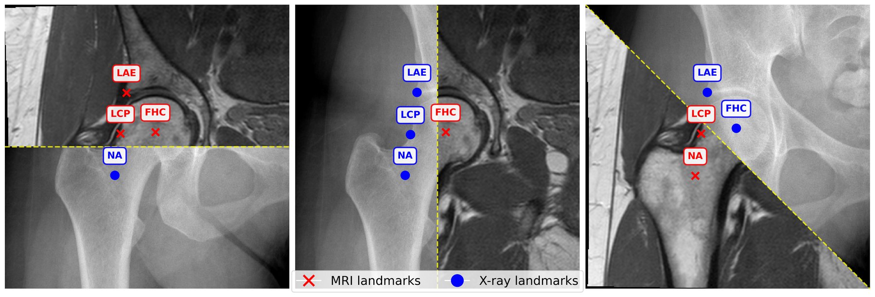 Paired anteroposterior pelvic X-ray and T1-weighted MRI (slice 10) of the same subject with the FHC, NA, LAE and LCP hip landmarks annotated