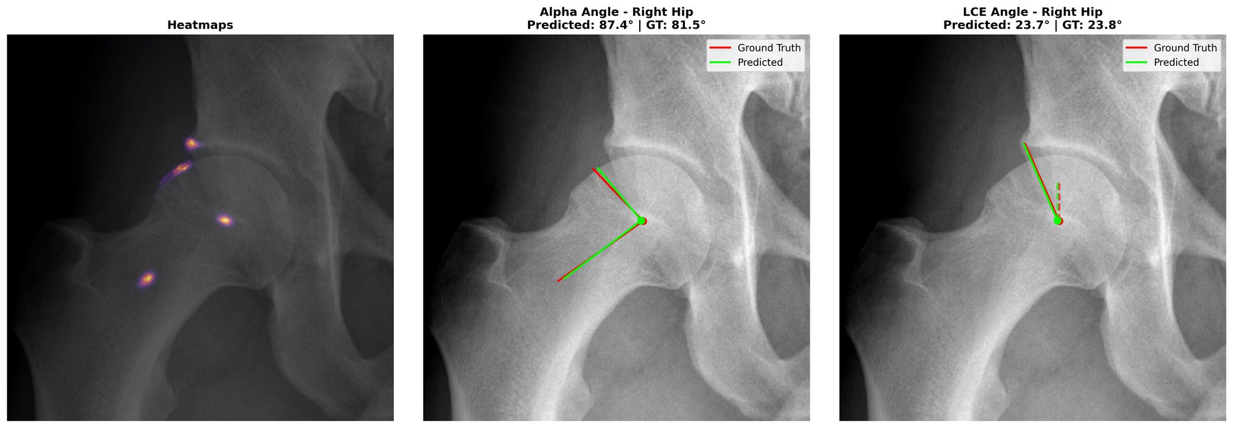 Automated landmark detection on the paired anteroposterior pelvic X-ray of the same hip: predicted landmark heatmaps, alpha angle and LCE angle, predicted (green) versus ground truth (red)