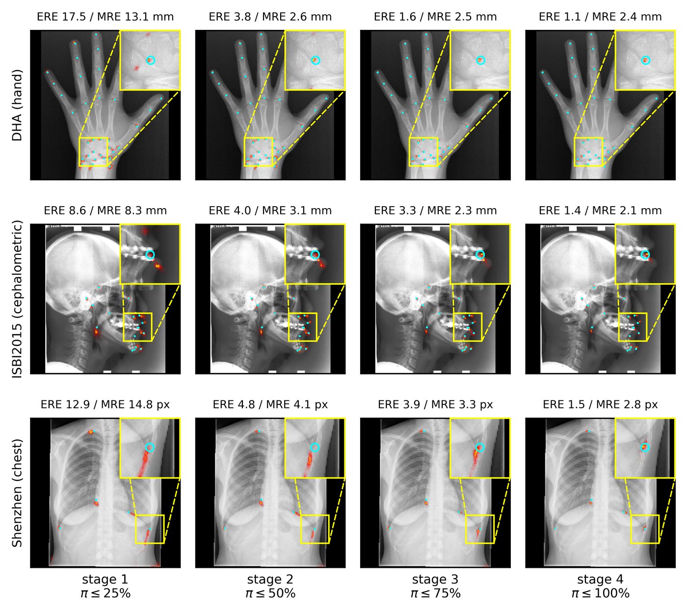 Predicted heatmaps of one hard pool image per dataset (hand, cephalometric, chest) across the four PACER curriculum stages, showing ERE and MRE decreasing as the gate opens